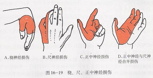 将指总伸肌与桡侧腕伸肌向两侧牵开,在旋后肌下缘可见穿出的深支及