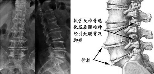 骨质增生的危害怎么样做能减少它