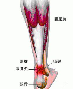 跟腱炎保健.jpg