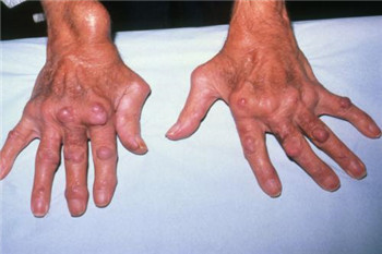 类风湿7.jpg 类风湿7.jpg