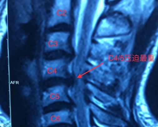 神经根型颈椎病.png